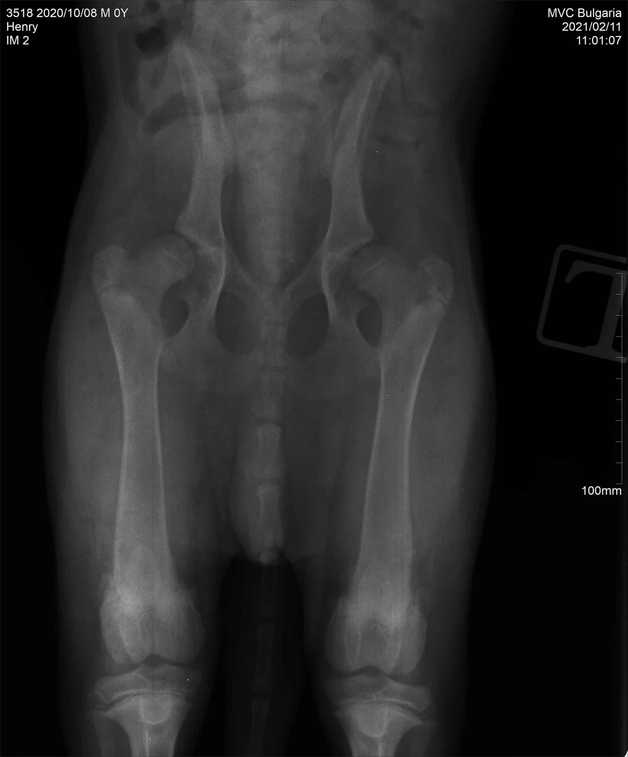" severe"  hip dysplasia 5 months old pup (x